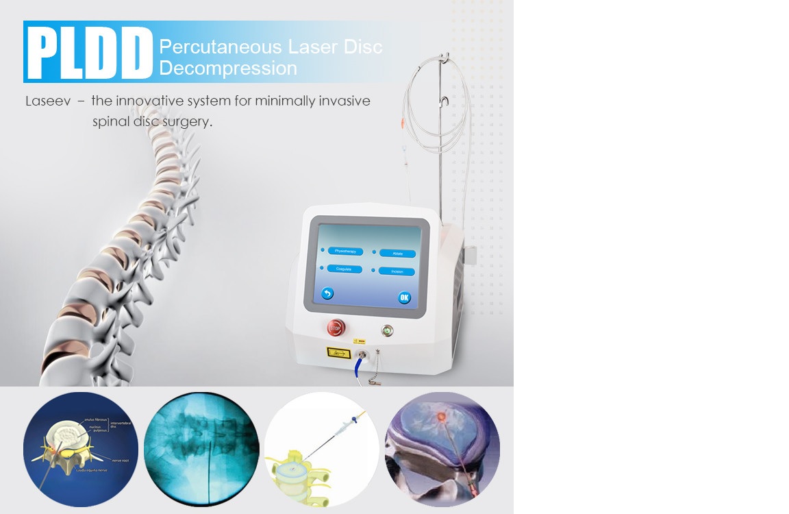 Máy giải nén đĩa đệm (PLDD) cho thoát vị đĩa đệm cột sống thắt lưng bằng Diode Laser với 02 bước sóng 980nm & 1470nm